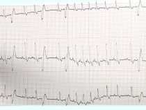 EKG (Rhythmusstörungen: VES, Hd) EKG (Rhythmusstörungen: VES, Hd)